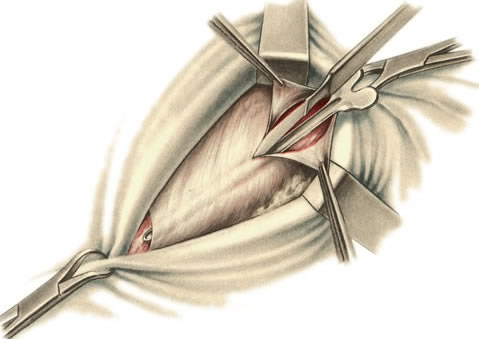 Рассечение апоневроза m. obliqui externi abdominis